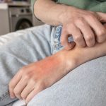 中醫調理乾癬 內外兼治 溫和改善皮膚困擾 擺脫紅疹瘙癢 重拾健康自信