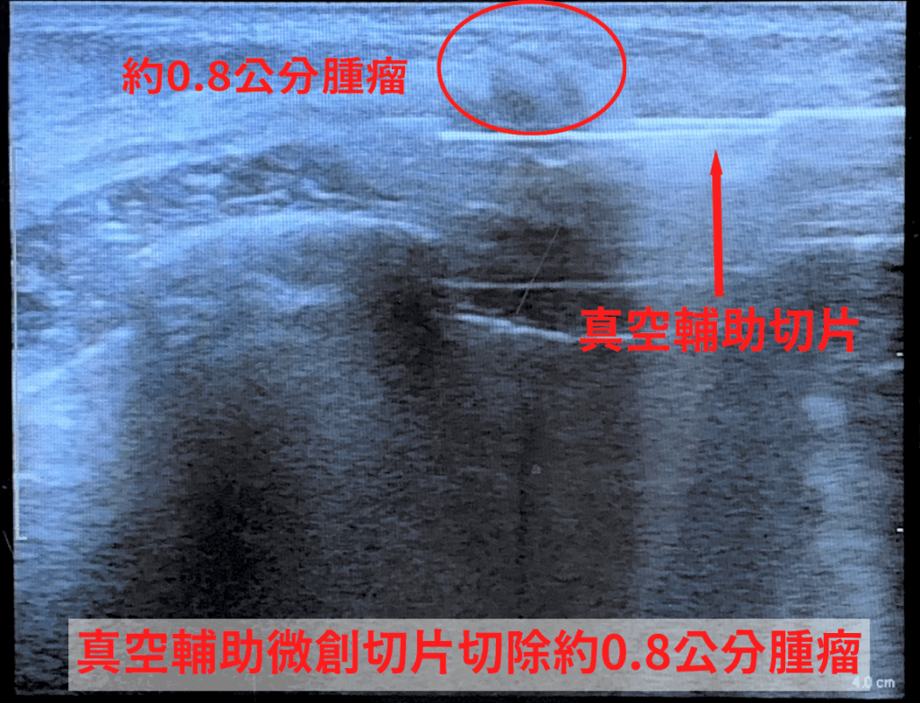 24歲年輕女性乳房疼痛 檢查竟是腫瘤作祟