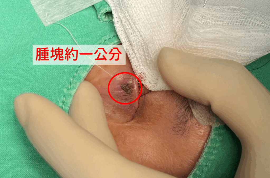 長期日曬導致眼皮下方生出腫塊 角化症影響視線 長期日曬導致眼皮下方生出腫塊 角化症影響視線