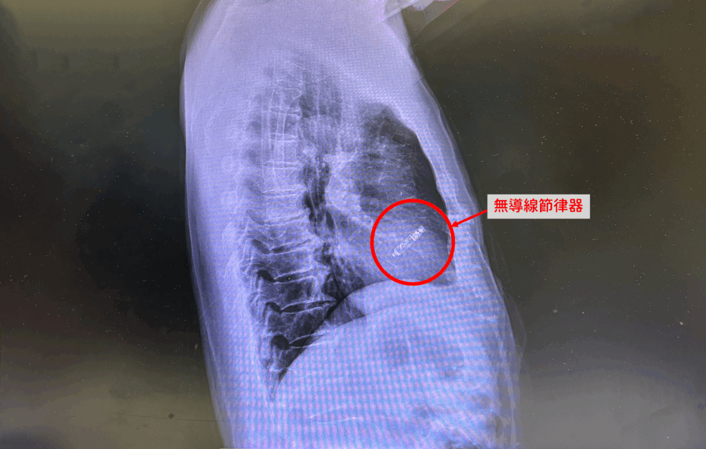 無導線節律器微創植入 改善心跳緩慢頭暈