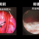 排尿困難別再忍 男子強忍至攝護腺肥大需動刀